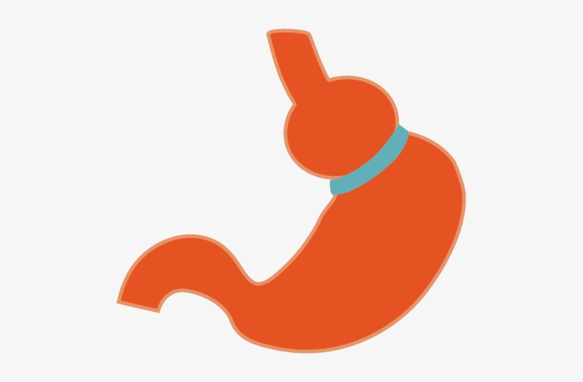 Laparoscopic Adjustable Gastric Band Is A Type Of Weight - Adjustable Gastric Band, transparent png #710452