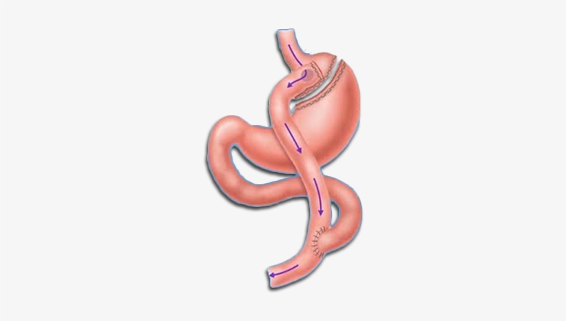 Bmi Calculator - Weight Loss Bypass Surgery, transparent png #710948