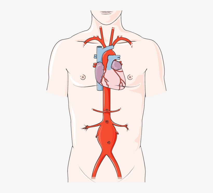 Abdominal Aortic Aneurysm - Cardiac Catheter Procedure, transparent png #716536