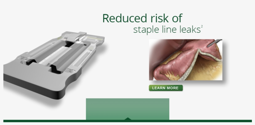 Staple Line Bleeding1*, transparent png #7216934