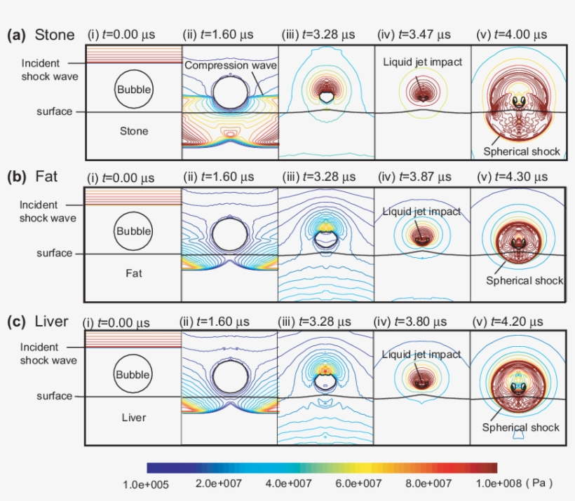 Bubble Collapse Near Stone, Fat, And Liver Boundaries, transparent png #7444775