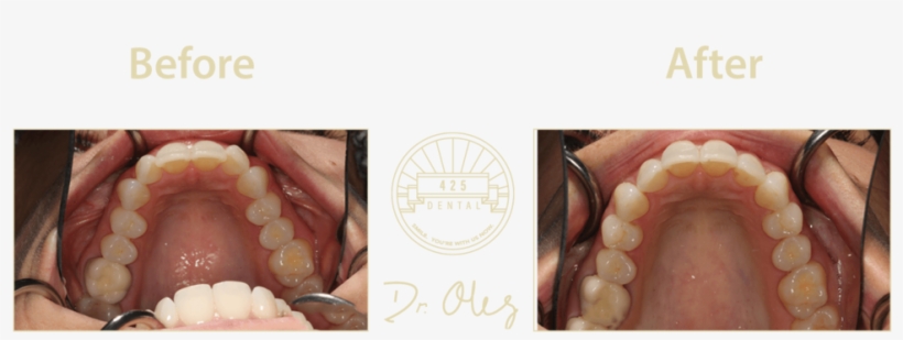 425 Before After Invisaline15, transparent png #7469654