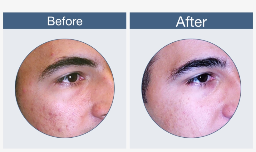 Clearogen Before & After, transparent png #7470204