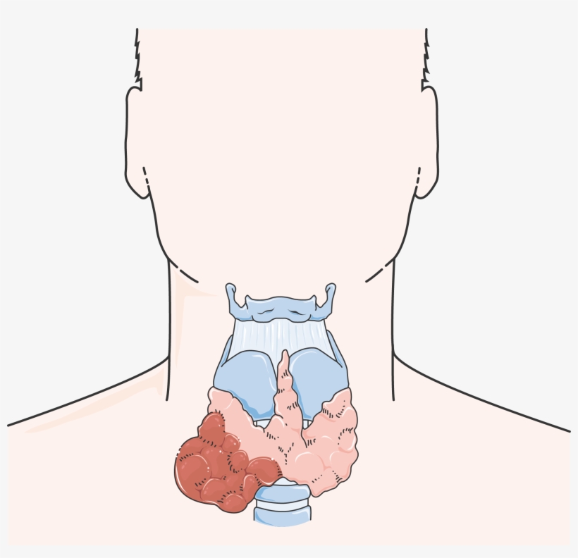 Cancer De La Thyroïde, transparent png #7476415