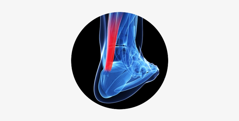 Elute® Fiber Is Driving A Paradigm Shift In Tissue - Entesopatia Do Tendao Calcaneo, transparent png #754291