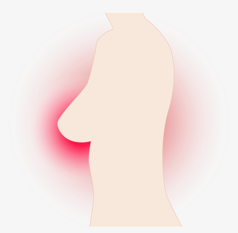 Breast,breast Cancer,cancer,breast Cancer - ภาพ มะเร็ง เต้า นม Png, transparent png #7592330