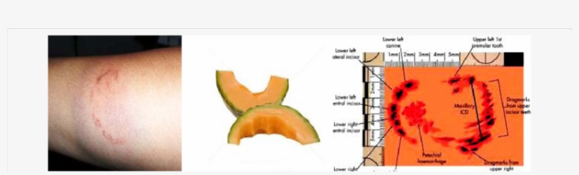 Images Shows Different Bite Marks On Human Skins And - Human Bite Marks, transparent png #763851