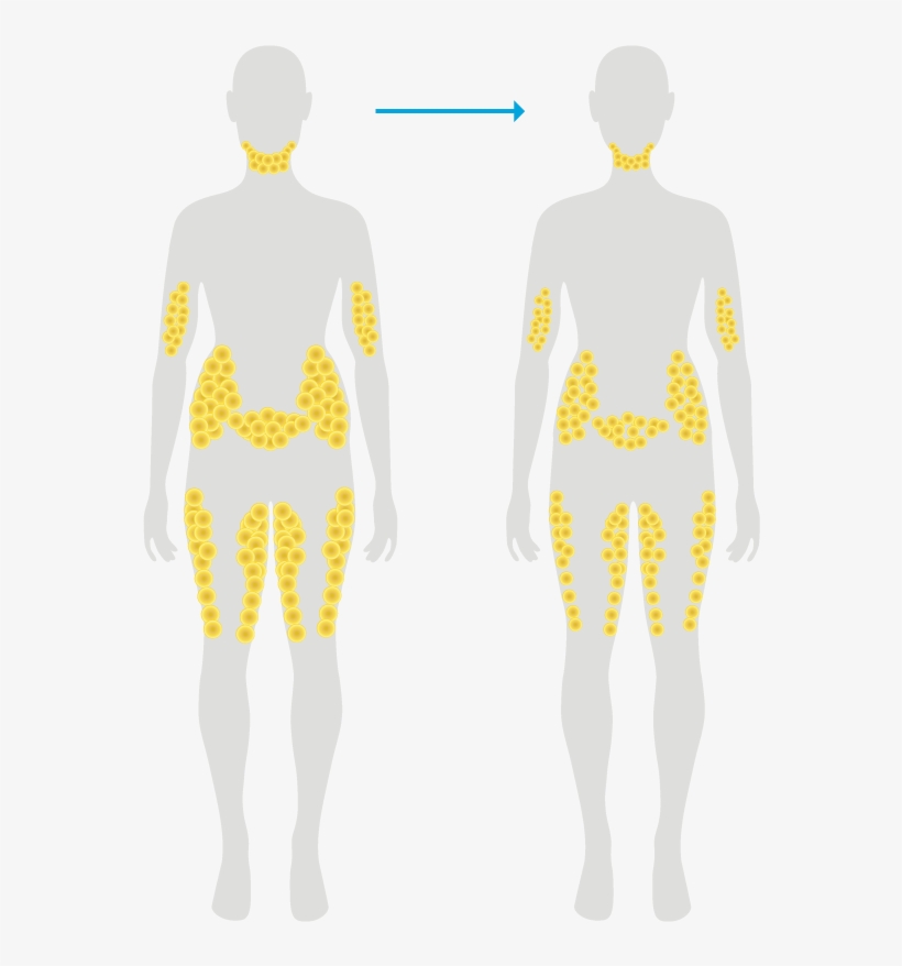 Fat Cells After Typical Weight Loss - Man, transparent png #769249