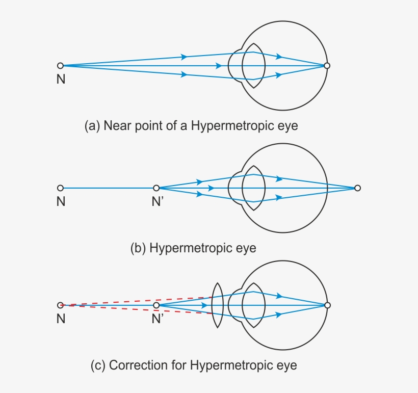 Presbyopia - Diagram, transparent png #7605384