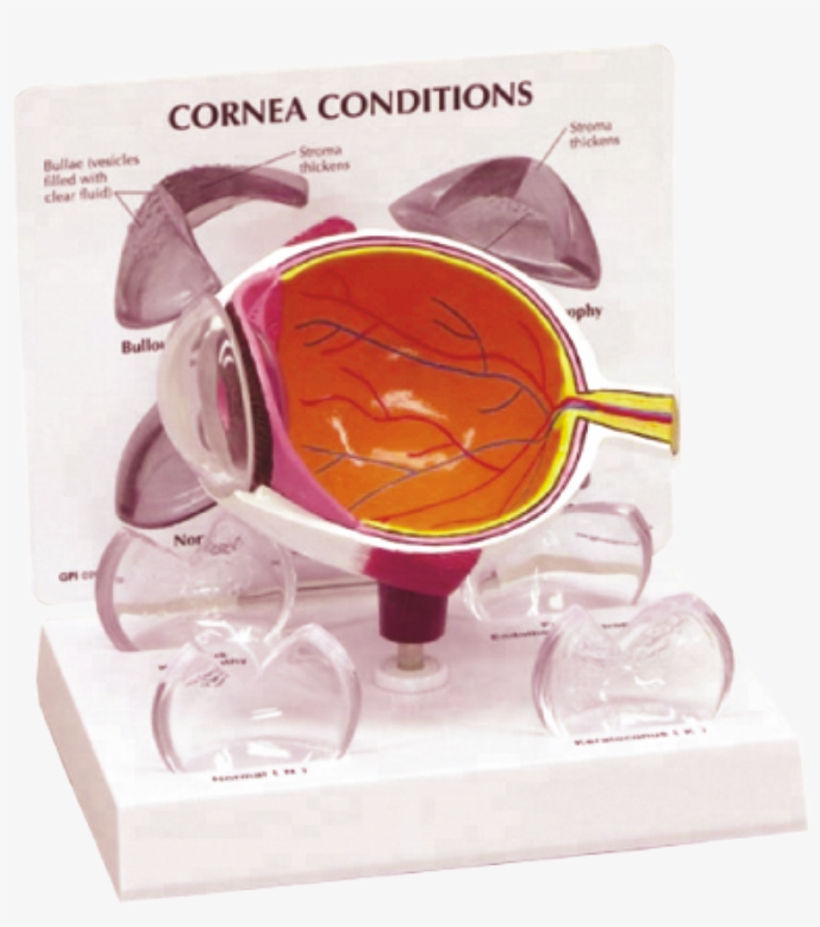 Human Eye Model With Pathological Cornea - Cornea On A Model, transparent png #7605431