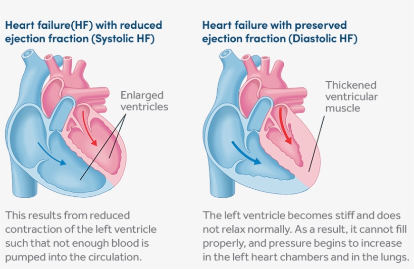 Two Types Of Heart Failure - Diagram, transparent png #7622870