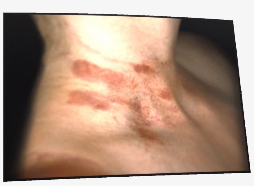 Bruises Png, transparent png #7624487