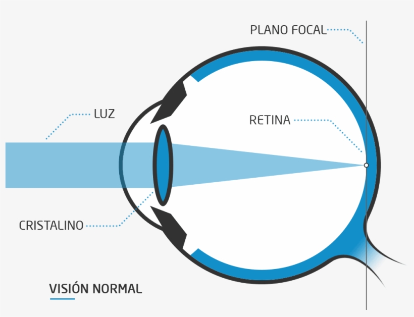 Como Consecuencia, Los Rayos De Luz No Llegan Correctamente - Ojo Con Miopia Png, transparent png #7635212