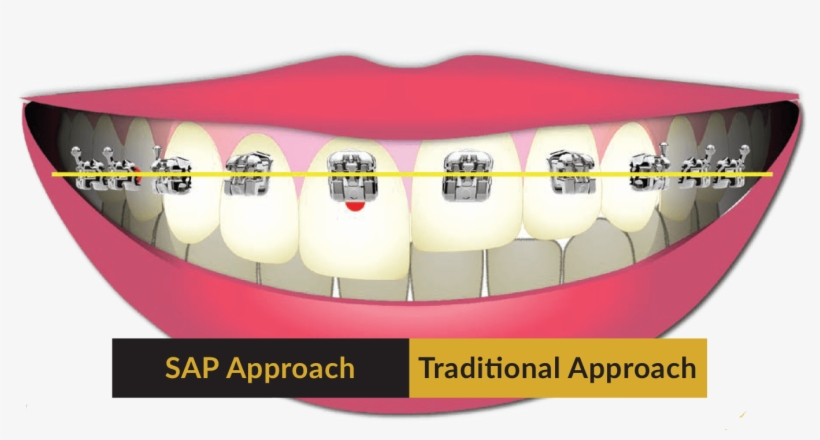 Saoly Benson Utilizes Smile Arc Protection When Treatment - Tongue, transparent png #7774831