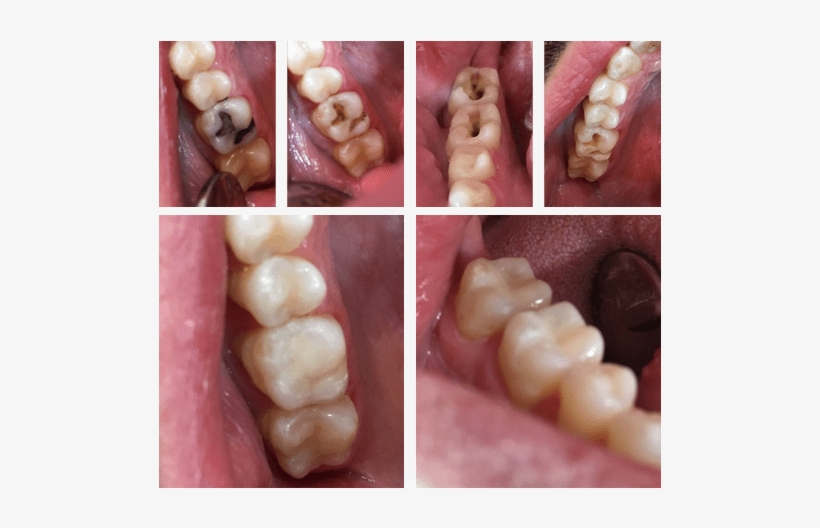 Utica Dental Fixing Old Mercury Fillings - Macro Photography, transparent png #7774874
