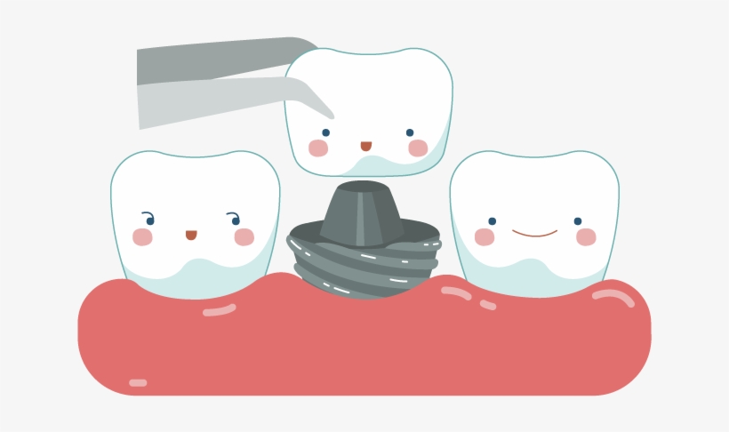 Dental Crowns & Bridges Sudbury Smiles Dentistry Picture - Dental Crown Cartoon, transparent png #7813243