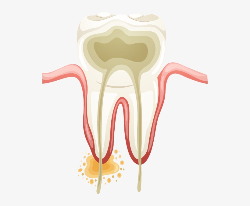 Root-canal1 - Endodontic Vector, transparent png #7824445
