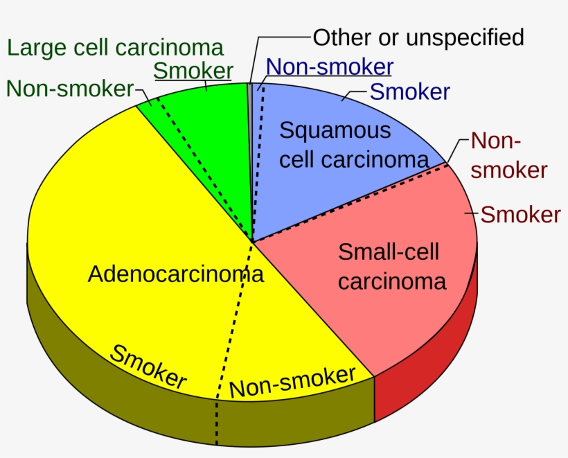 Lung Cancer Pie Chart, transparent png #7837158