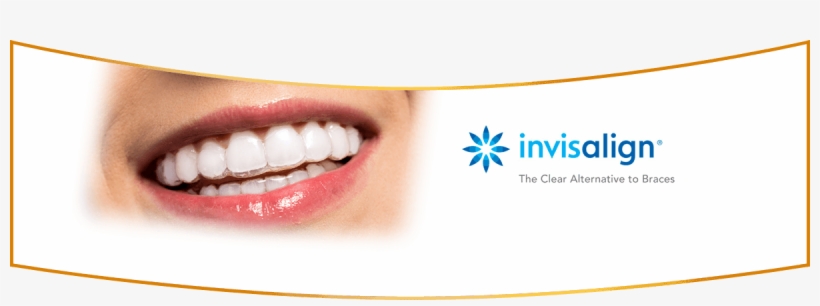 Invisalign San Luis Obispo Ca - Clear Aligners, transparent png #7907866