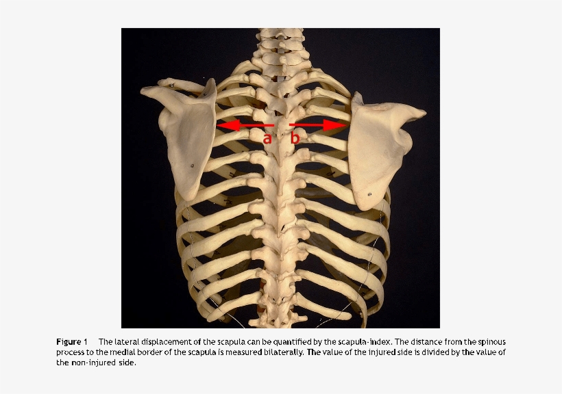 Ct Imaging May Demonstrate Widening Of The Scapulothoracic - Rib, transparent png #7975733