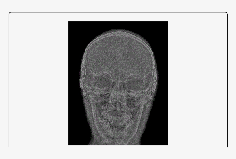 Plain Trans Orbital Skull Film Taken Intra Operatively - Medical Imaging, transparent png #7988812