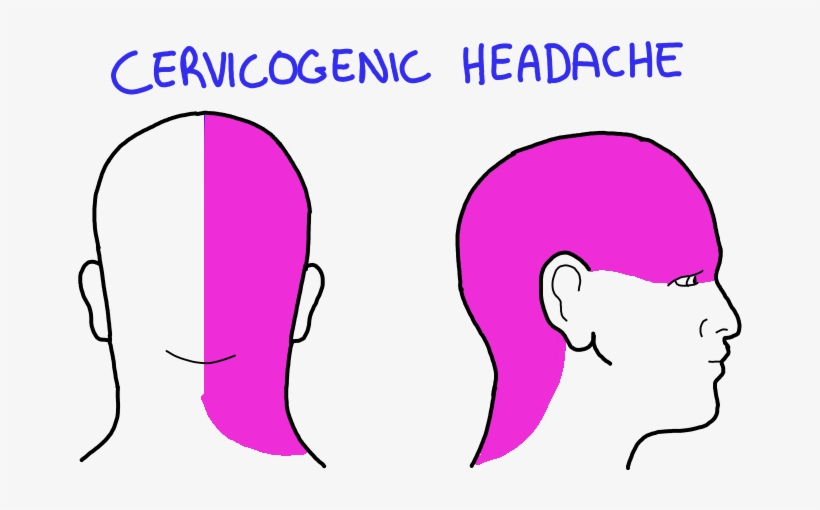 Cervicogenic-headache - Cervicogenic Headache, transparent png #8002602
