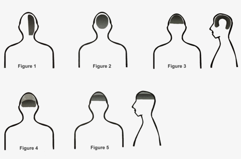 Headaches - Tight Band Feeling Around Head, transparent png #8003024