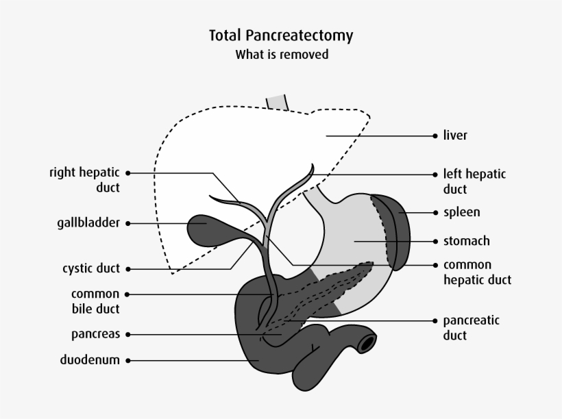 Diagram Of What Is Removed In A Total Pancreatectomy - Pancréatectomie Totale, transparent png #8030218