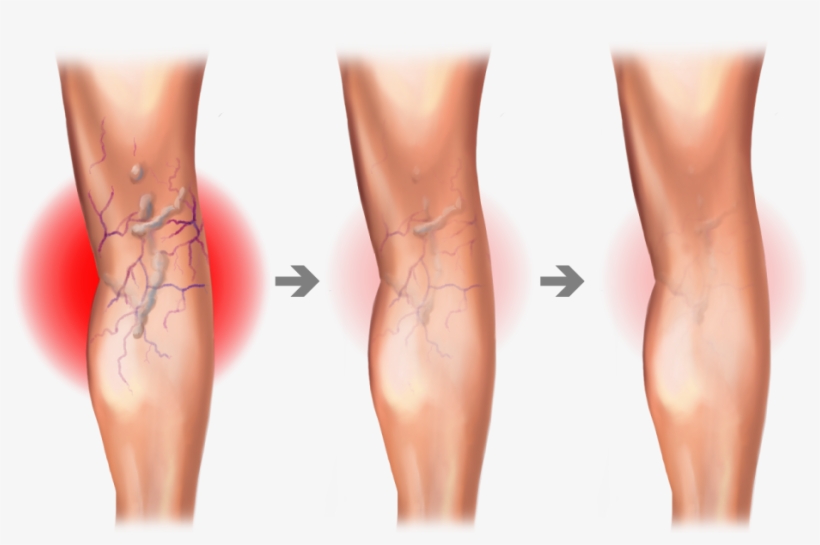 Spider And Varicose Vein Treatment Center - Varicose Vein Graphic - Free Transparent PNG Download - PNGkey