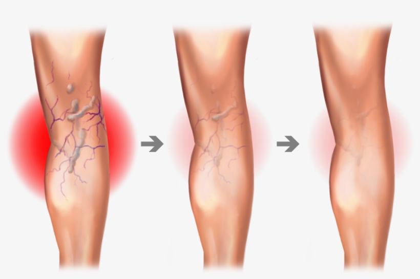 Spider And Varicose Vein Treatment Center - Varicose Vein Graphic, transparent png #8147361