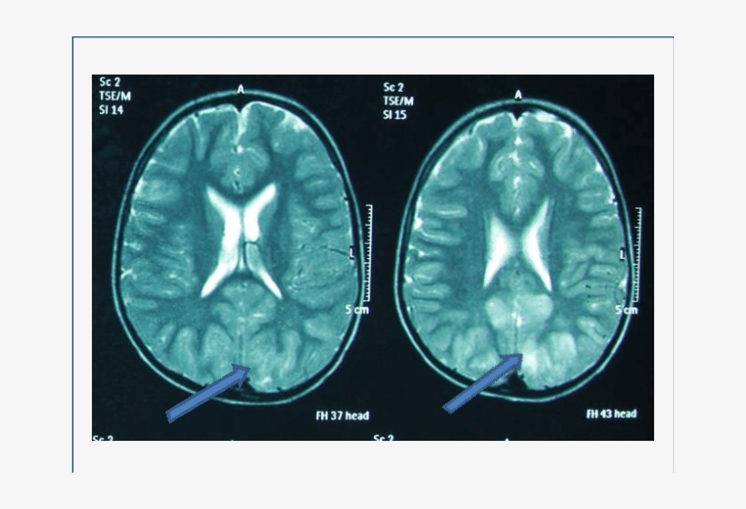 Pointers Indicating Hyper Intensity Areas In White - Computed Tomography, transparent png #8163703