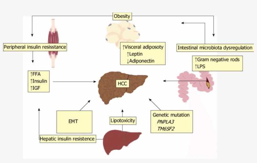 The Development Of Nafld And Nash-related Hcc Is Multifactorial - Emt Nash Hcc, transparent png #8228373