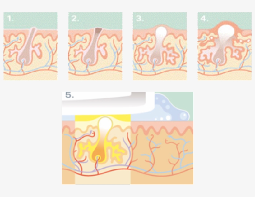 Acne And Rosacea - C1 Advanced, transparent png #8268539