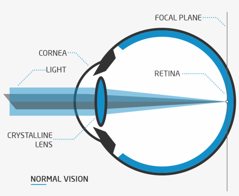Astigmatism Surgery - Ojo Con Miopia Png, transparent png #8297498