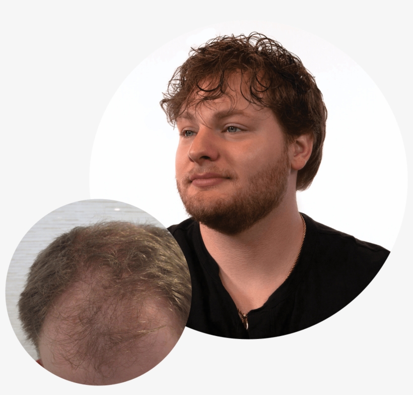 Non-surgical Hair Replacement For Men, transparent png #8306132