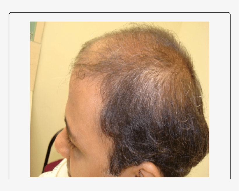 Improved Hair Growth Within 4 Months After Changing - Girl, transparent png #8306161