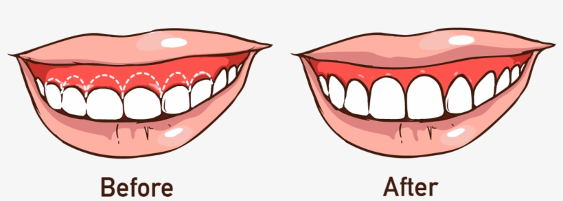 Transforming Your Entire Smile - Gingivectomy, transparent png #8307284
