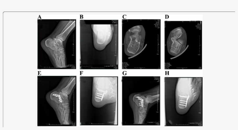 A 45 Year Old Male Patient Was Admitted To Our Hospital - Minimally Invasive Calcaneal Fracture, transparent png #8356357