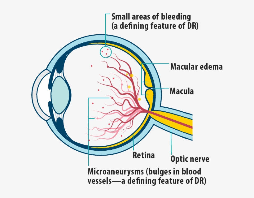 Picture Of Effects Of Dme/dr In Dme On The Eye, Showing - Diagram, transparent png #8361503