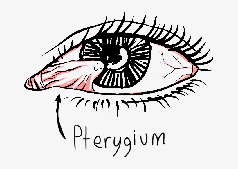 A Pterygium Is A Pinkish To Dark Red Triangular Wing, transparent png #8361563