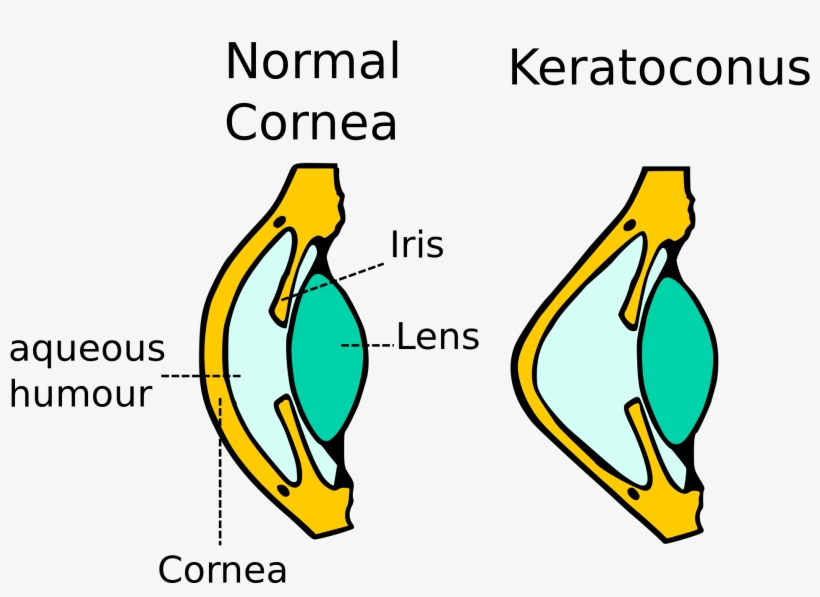 Kerataconus Image - Does Keratoconus Work, transparent png #8373627