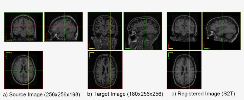 Registration Of Raw Brain Images - Computed Tomography, transparent png #8393844
