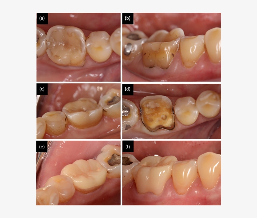 The Lower First Molar Tooth Has Large Resin Composite - Medical, transparent png #8421818