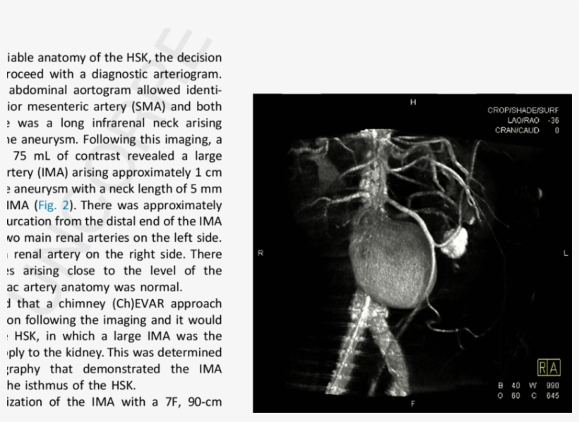 Horseshoe Kidney Classification System Based On The, transparent png #8423926