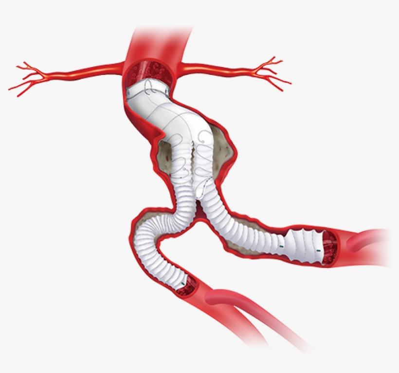 Product Availability Subject To Local Regulatory Approval - Anaconda Graft, transparent png #851461
