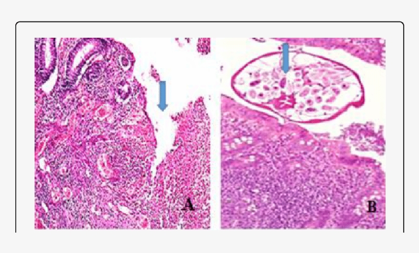 Entrobius Vermicularis In Appendix - Motif, transparent png #8500644