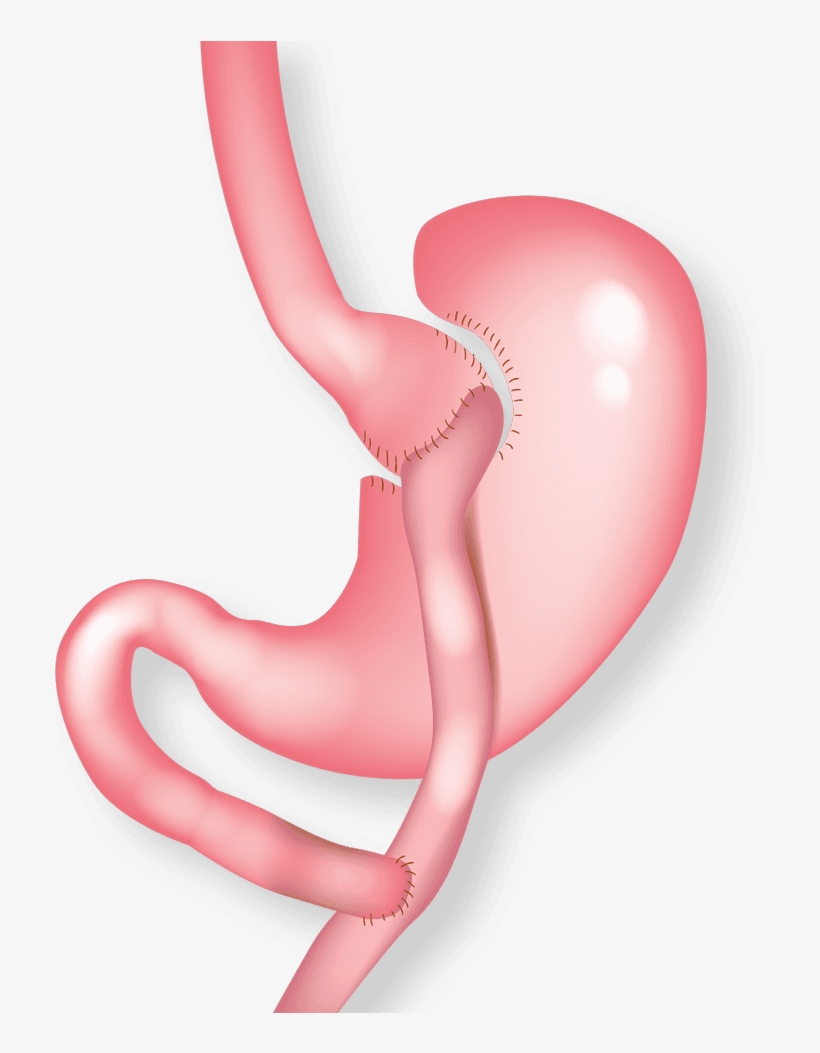Illustration Of Gastric Bypass - Balloon, transparent png #8574437