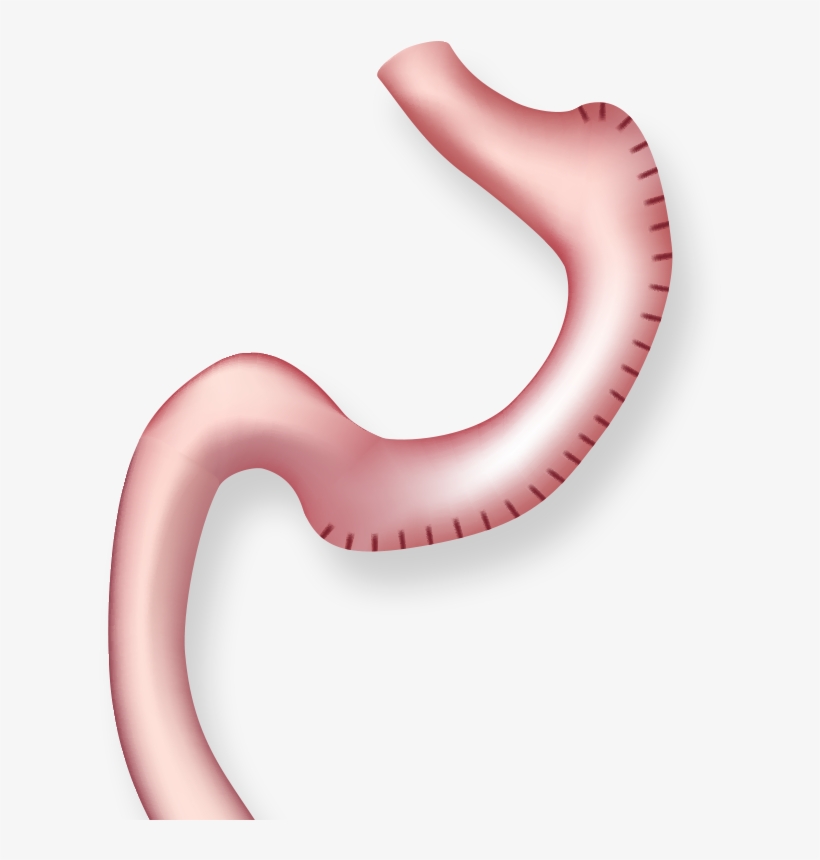 Illustration Of Stomach After Gastric Plication - Tüp Mide Ameliyatı, transparent png #8574874