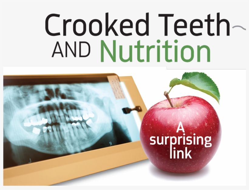 Crooked Teeth And Nutrition By Dr - Apple, transparent png #8682207