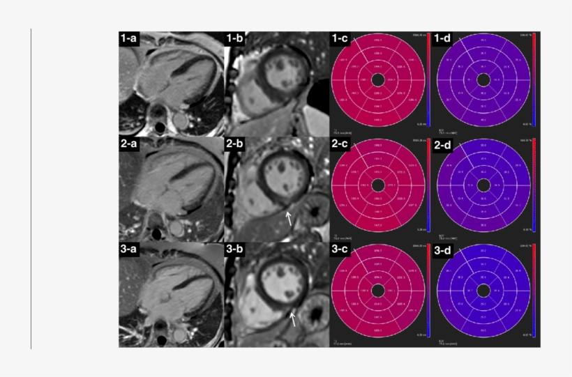 Lge Images, Native T1 And Ecv Bull's Eye Plots Of A - Circle, transparent png #870048